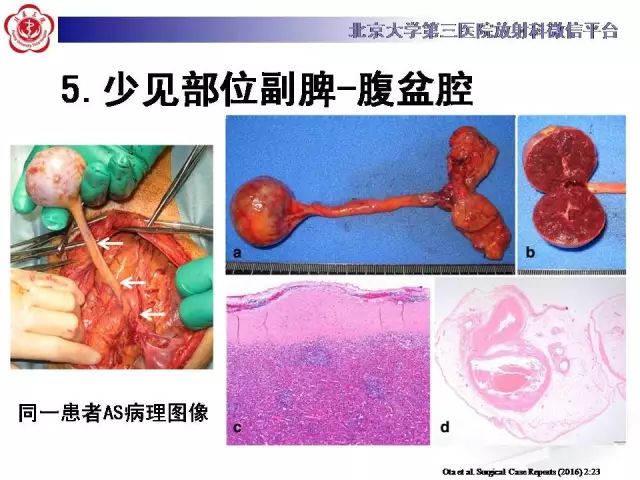 【病例】盆腔副脾蒂扭转1例CT