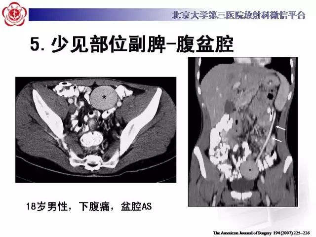 【病例】盆腔副脾蒂扭转1例CT