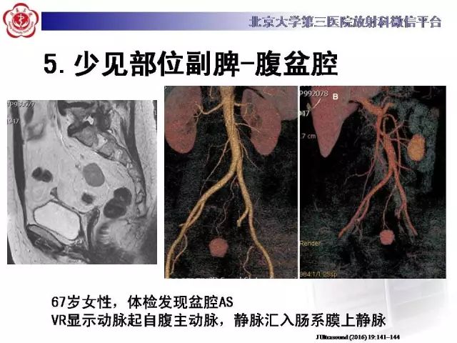 【病例】盆腔副脾蒂扭转1例CT