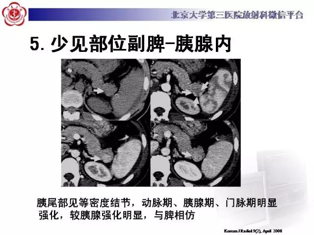 【病例】盆腔副脾蒂扭转1例CT