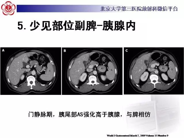 【病例】盆腔副脾蒂扭转1例CT