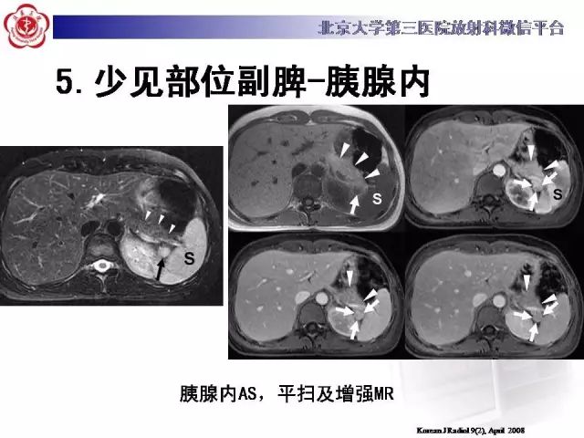 【病例】盆腔副脾蒂扭转1例CT