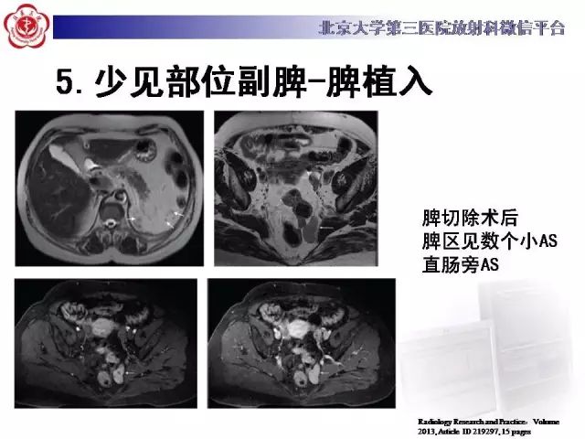 【病例】盆腔副脾蒂扭转1例CT