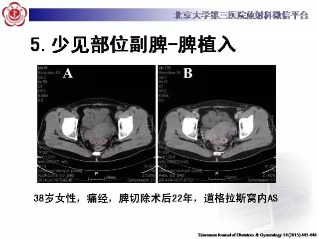 【病例】盆腔副脾蒂扭转1例CT
