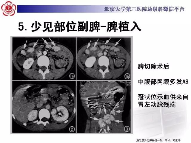 【病例】盆腔副脾蒂扭转1例CT