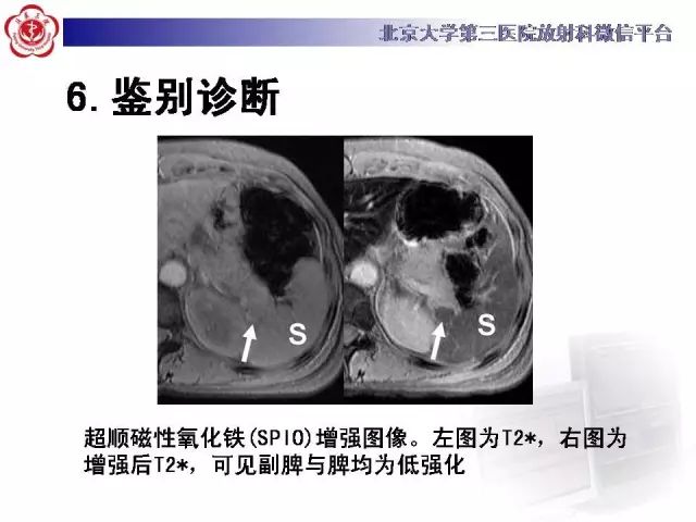 【病例】盆腔副脾蒂扭转1例CT