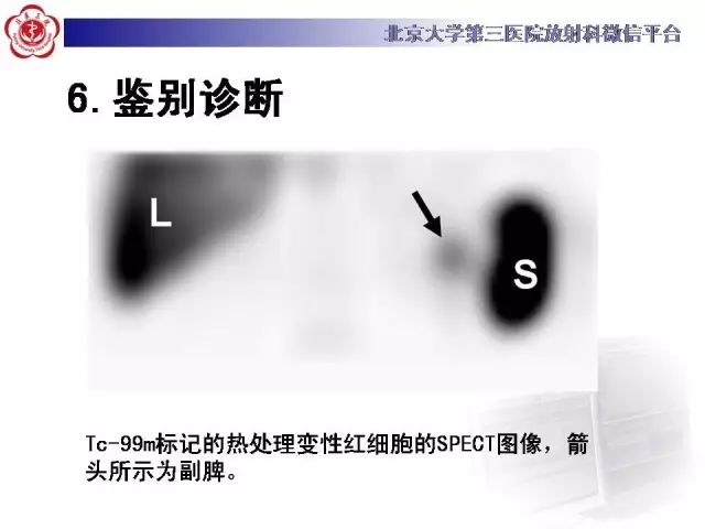 【病例】盆腔副脾蒂扭转1例CT