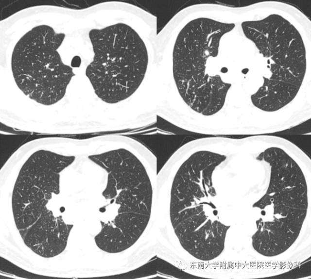 【病例】结节病1例CT