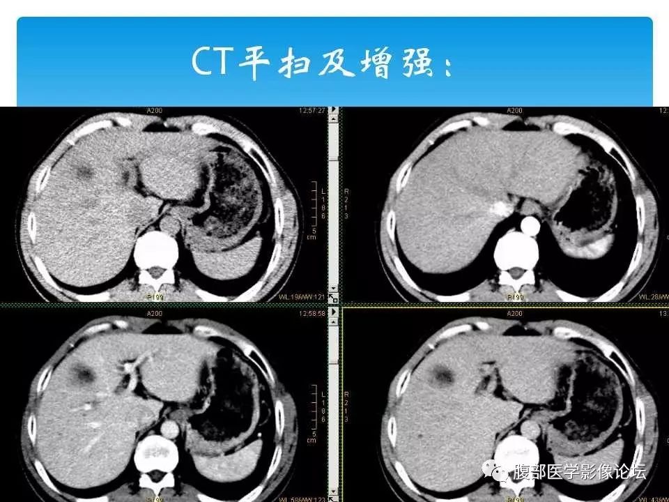 【病例】原发性肝癌1例CT及MR