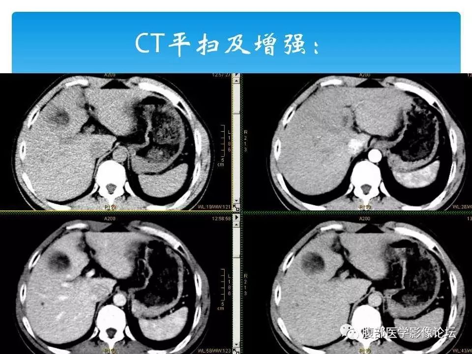 【病例】原发性肝癌1例CT及MR