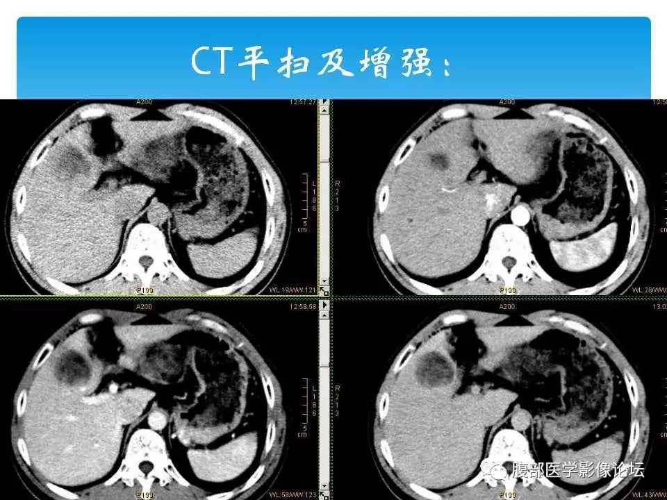 【病例】原发性肝癌1例CT及MR