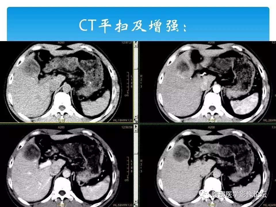 【病例】原发性肝癌1例CT及MR