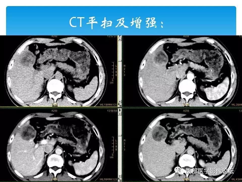 【病例】原发性肝癌1例CT及MR