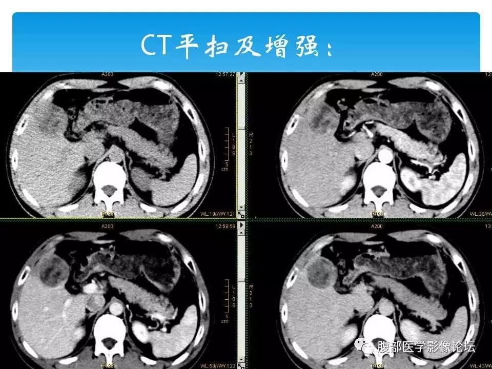 【病例】原发性肝癌1例CT及MR
