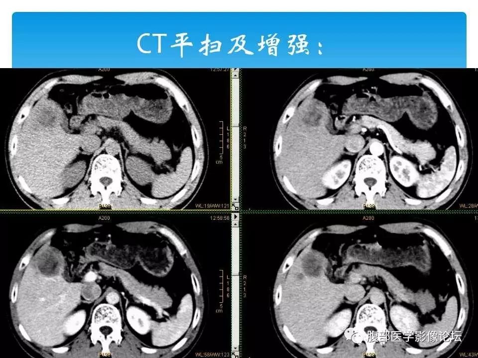 【病例】原发性肝癌1例CT及MR
