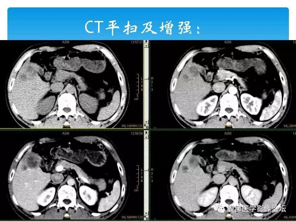 【病例】原发性肝癌1例CT及MR