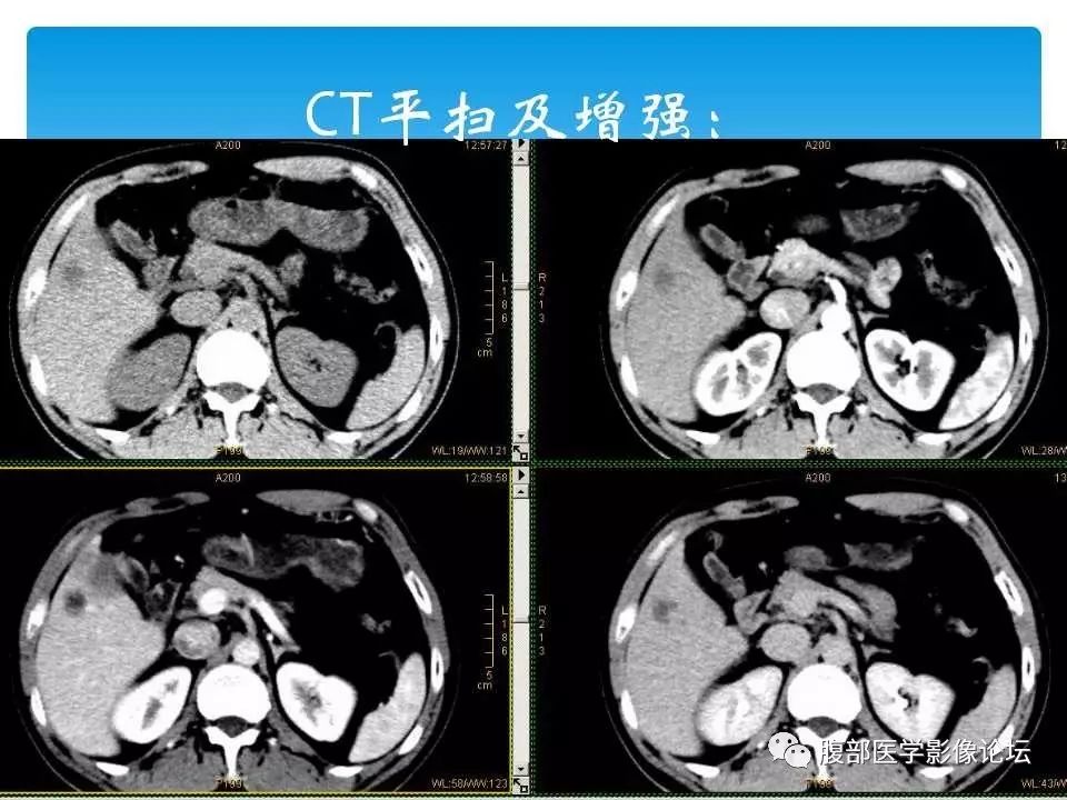 【病例】原发性肝癌1例CT及MR