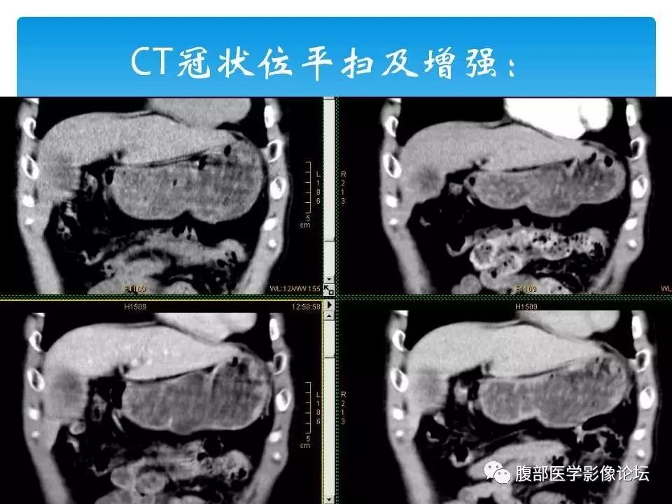 【病例】原发性肝癌1例CT及MR