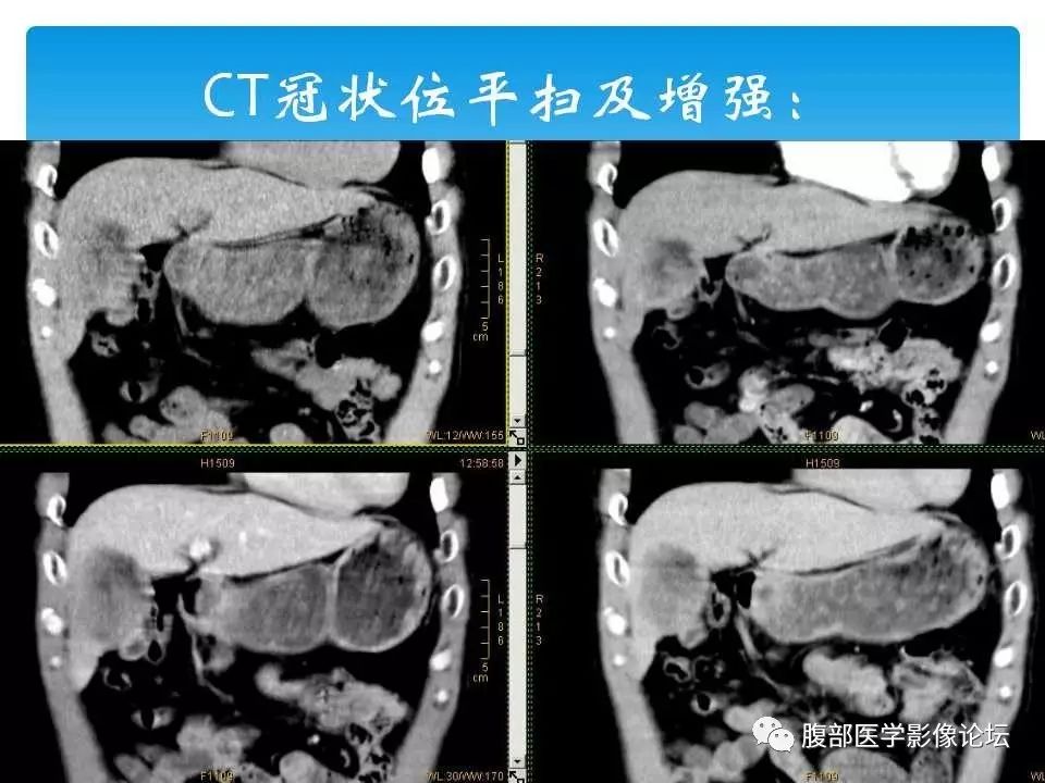 【病例】原发性肝癌1例CT及MR