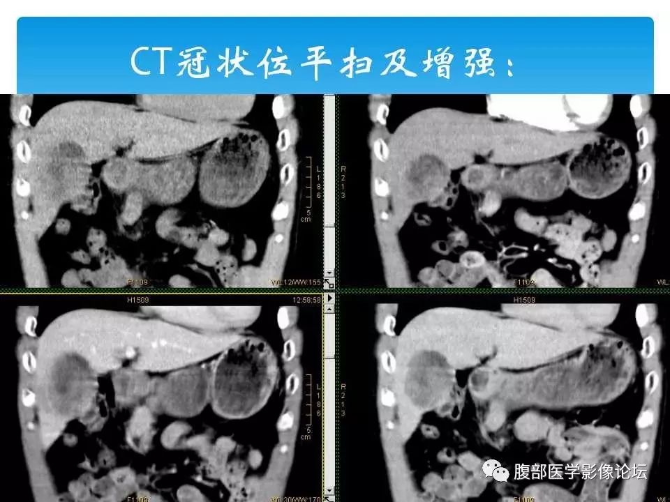 【病例】原发性肝癌1例CT及MR