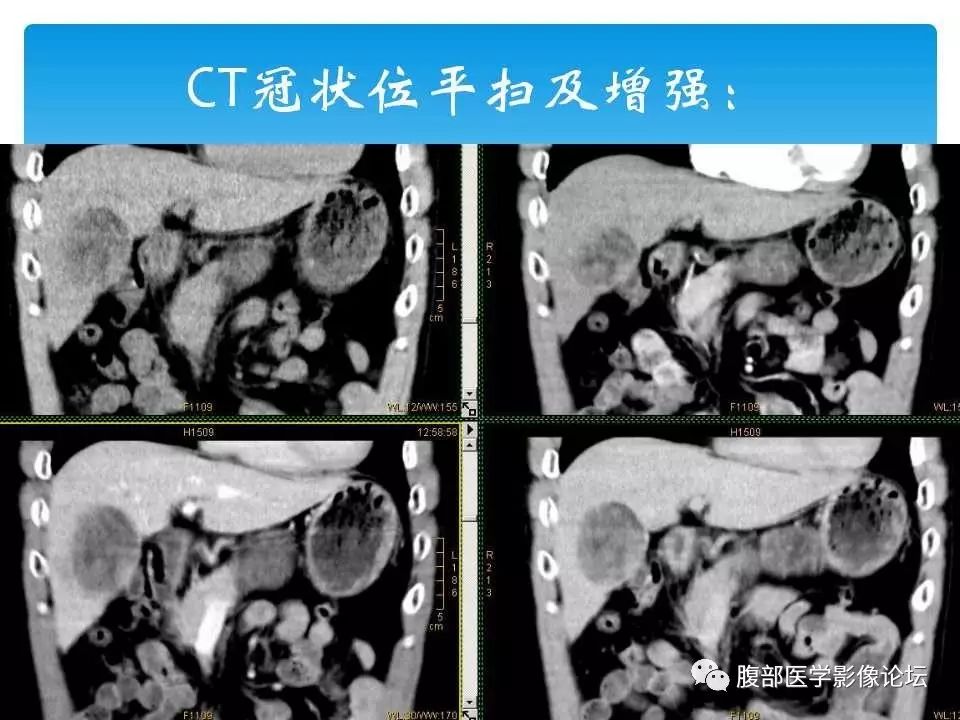 【病例】原发性肝癌1例CT及MR