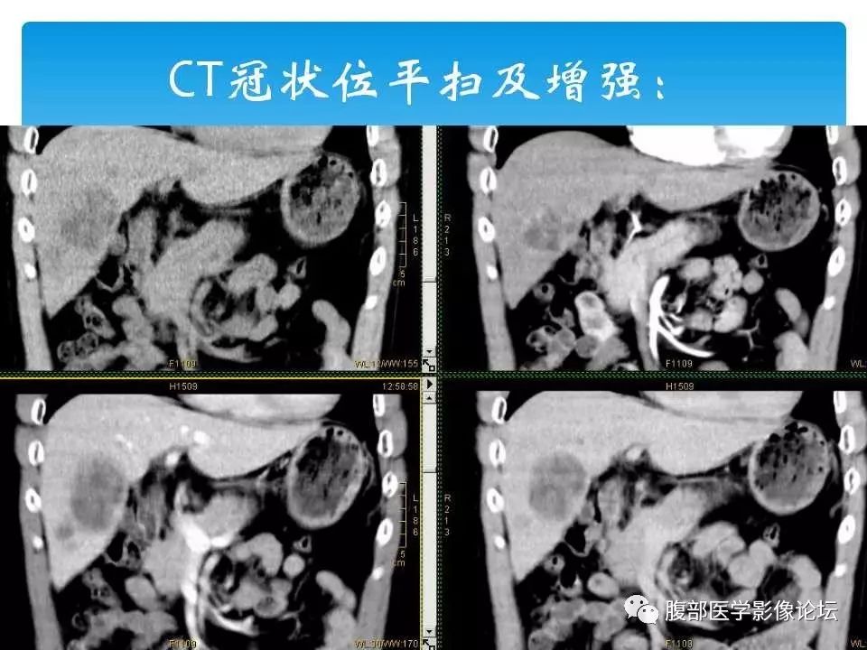 【病例】原发性肝癌1例CT及MR