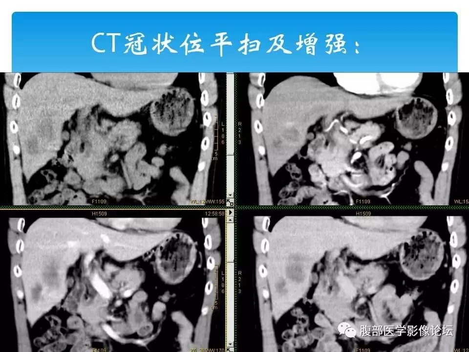 【病例】原发性肝癌1例CT及MR