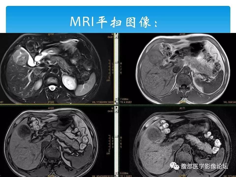【病例】原发性肝癌1例CT及MR