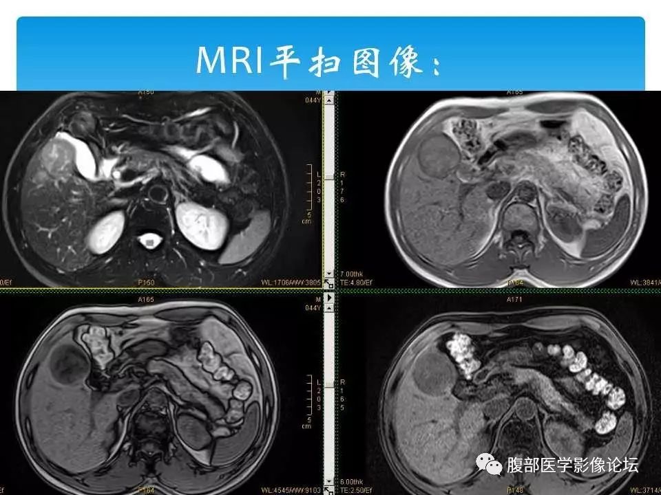 【病例】原发性肝癌1例CT及MR