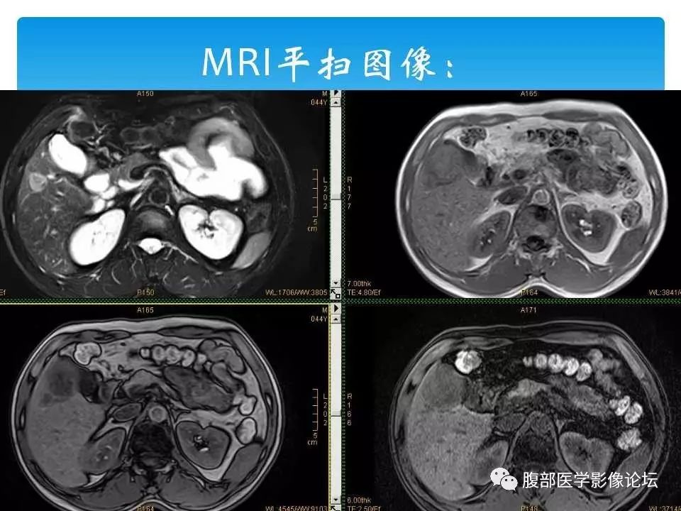 【病例】原发性肝癌1例CT及MR