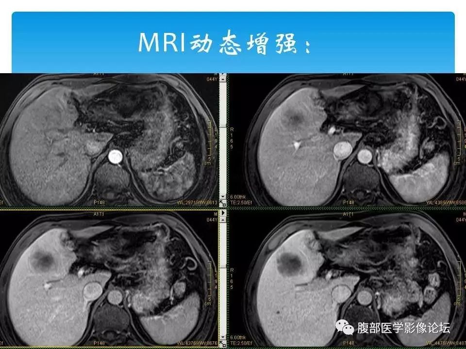 【病例】原发性肝癌1例CT及MR