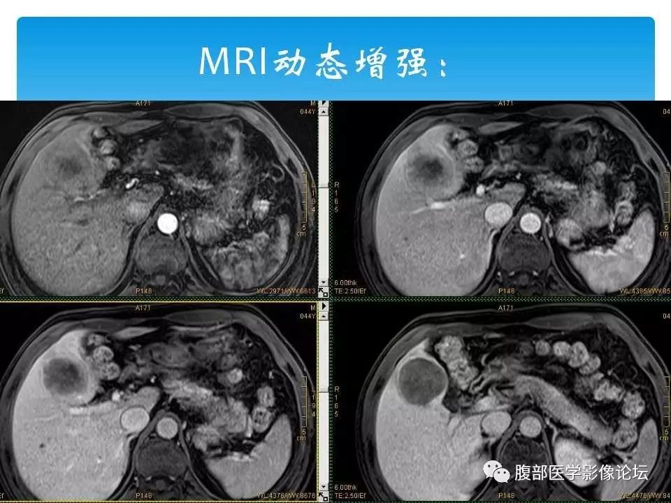 【病例】原发性肝癌1例CT及MR
