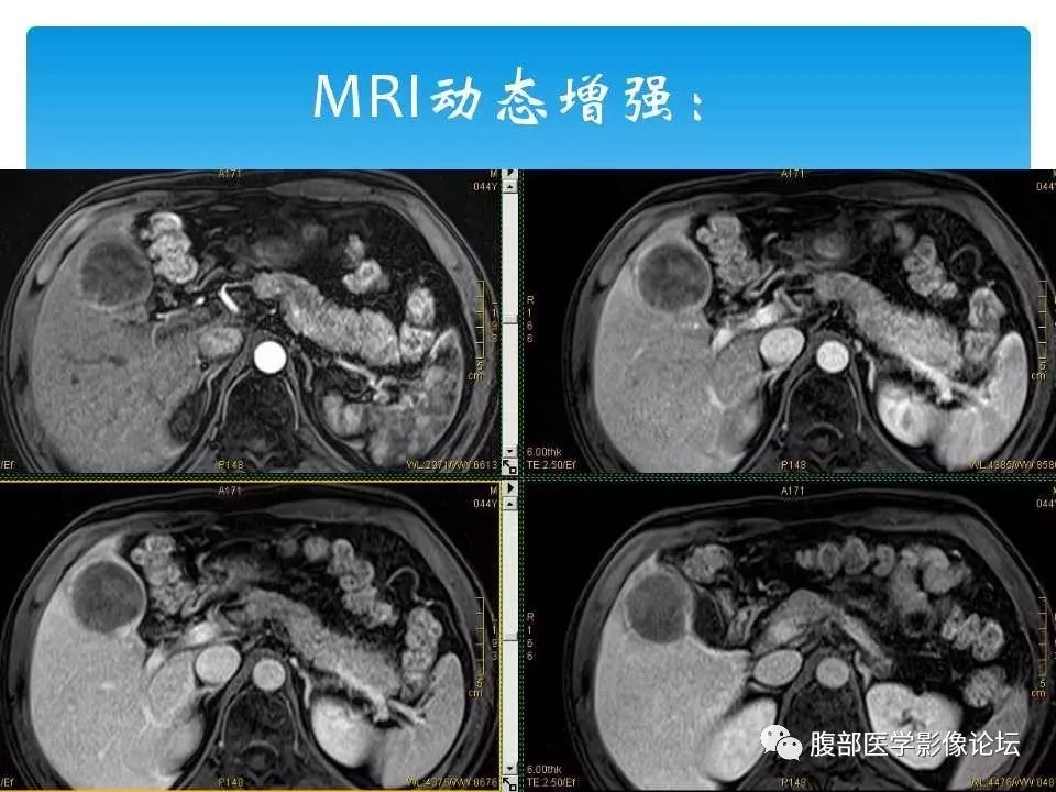 【病例】原发性肝癌1例CT及MR