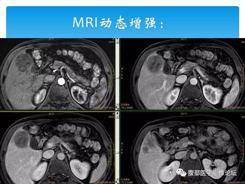 【病例】原发性肝癌1例CT及MR