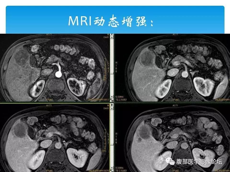 【病例】原发性肝癌1例CT及MR