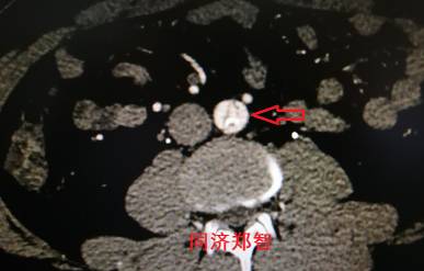 诊断主动脉夹层,有时候就在这一刹那 诊断主动脉夹层,有时候就在这一刹那