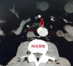 诊断主动脉夹层,有时候就在这一刹那 诊断主动脉夹层,有时候就在这一刹那
