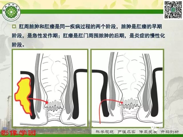 【PPT】复杂性肛瘘的MRI诊断