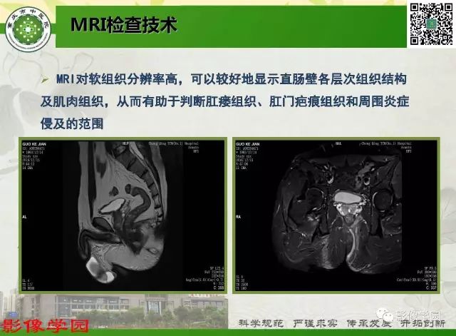 【PPT】复杂性肛瘘的MRI诊断