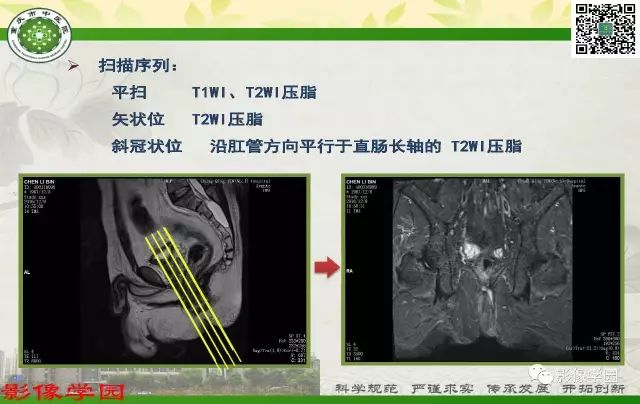 【PPT】复杂性肛瘘的MRI诊断