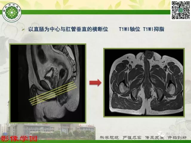 【PPT】复杂性肛瘘的MRI诊断