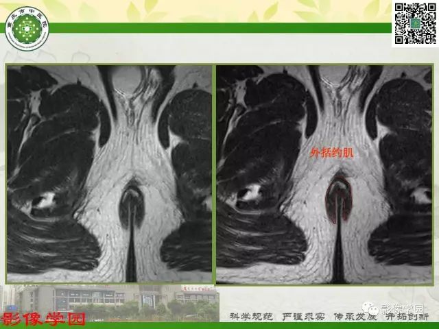 【PPT】复杂性肛瘘的MRI诊断