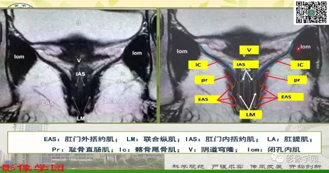【PPT】复杂性肛瘘的MRI诊断