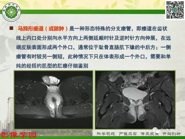 【PPT】复杂性肛瘘的MRI诊断