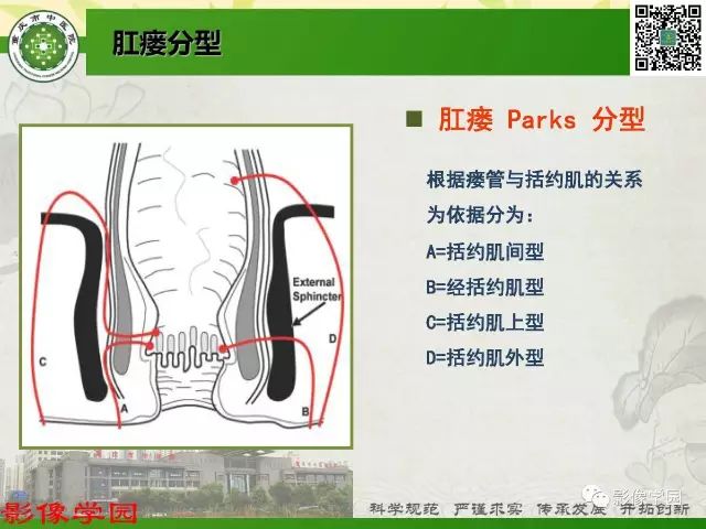 【PPT】复杂性肛瘘的MRI诊断
