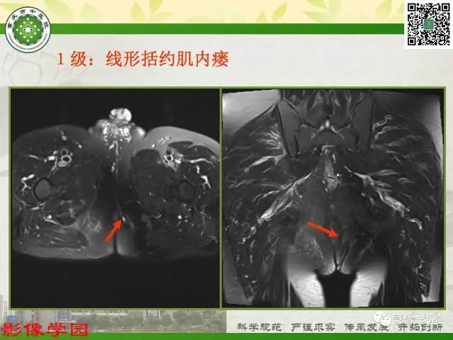 【PPT】复杂性肛瘘的MRI诊断