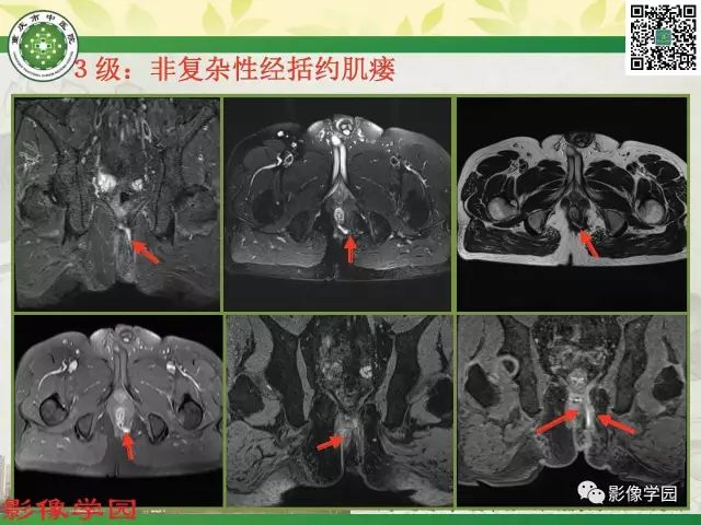 【PPT】复杂性肛瘘的MRI诊断