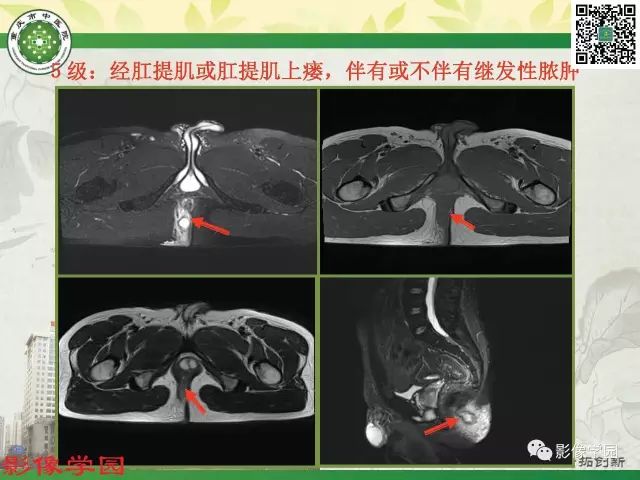 【PPT】复杂性肛瘘的MRI诊断