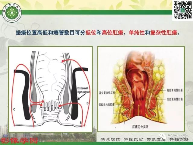 【PPT】复杂性肛瘘的MRI诊断