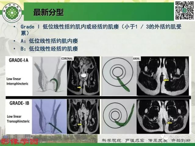 【PPT】复杂性肛瘘的MRI诊断